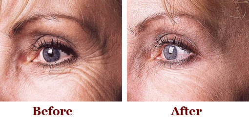 Crows Feet Botox Before and After